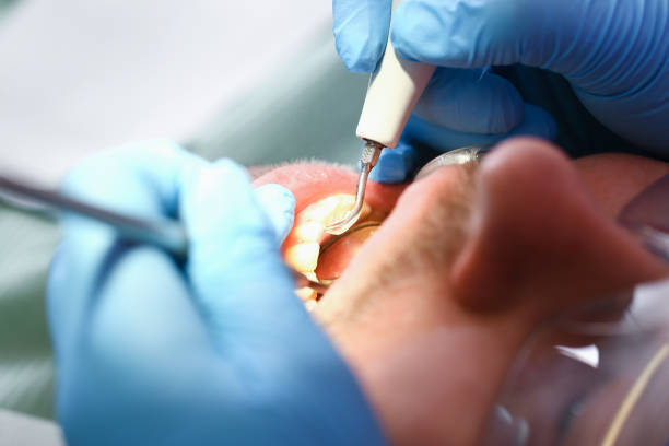 Best Emergency Dentist for Knocked-Out Tooth in Key West, FL